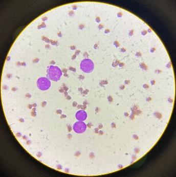 Myeloblasts