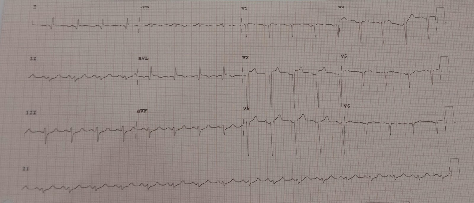 STEMI2