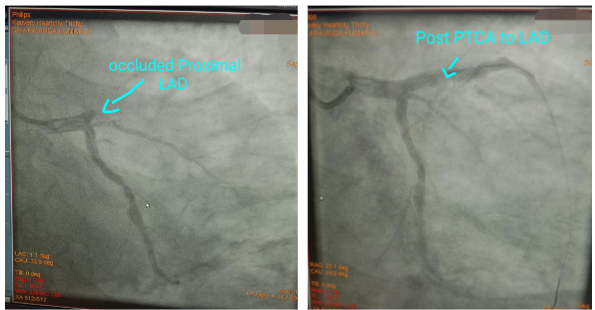 STEMI3