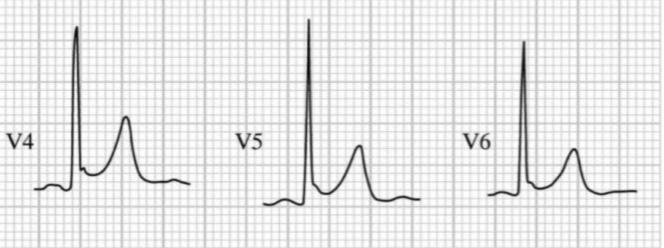 STEMI4