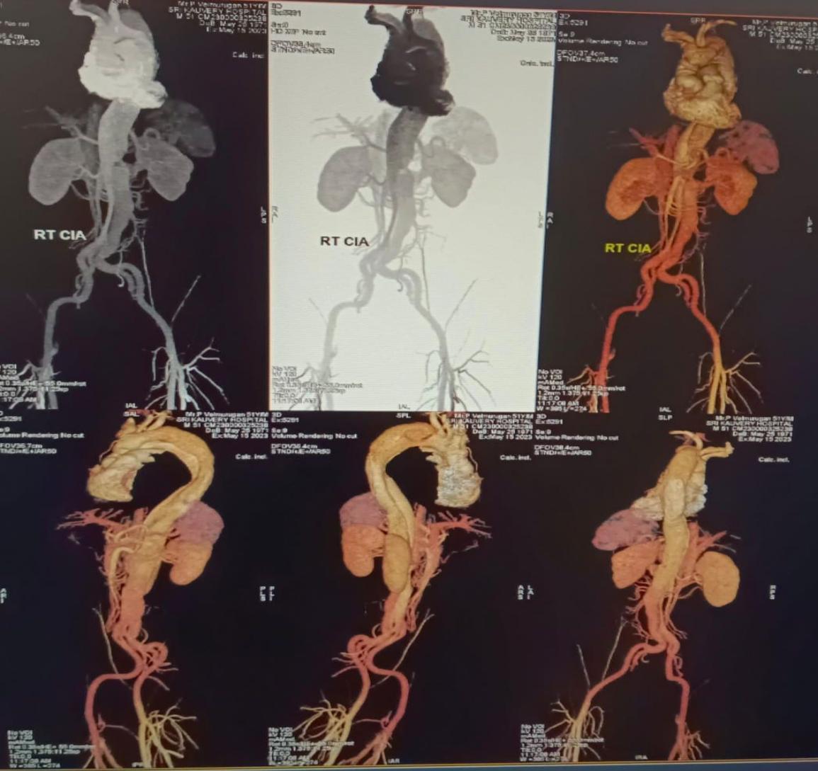 FROZEN ELEPHANT TRUNK (FET) PROCEDURE IN A 52 YEARS OLD CHRONIC AORTIC