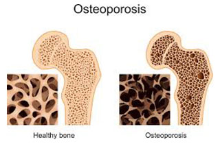 osteoporosis_2