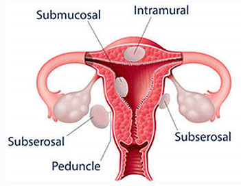 fibroids