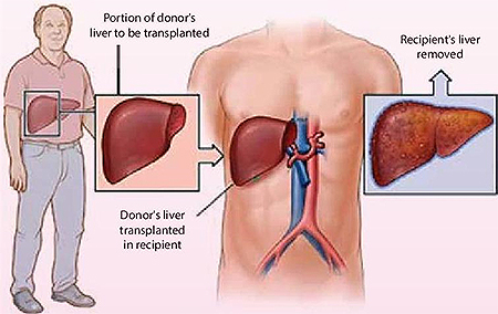 What is a Liver Transplant?
