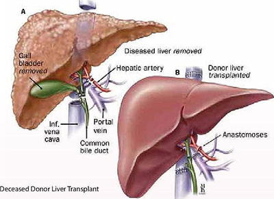 Deceased Donor Transplants