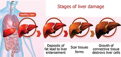 Stage of liver damage