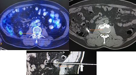 image-guided-biopsies