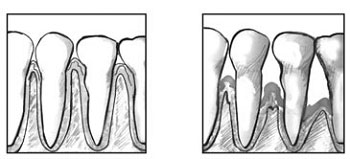 diabetes-gum-disease-other-dental-problems-2