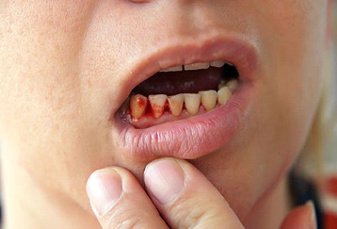 diabetes-gum-disease-other-dental-problems-3