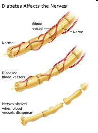 diabetes-mellitus-and-neurology-3