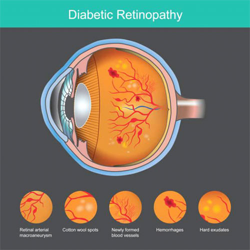 diabetic-retinopathy-understanding-the-eye-disease-2
