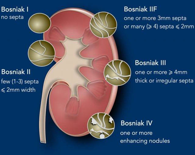 renal-cysts-2