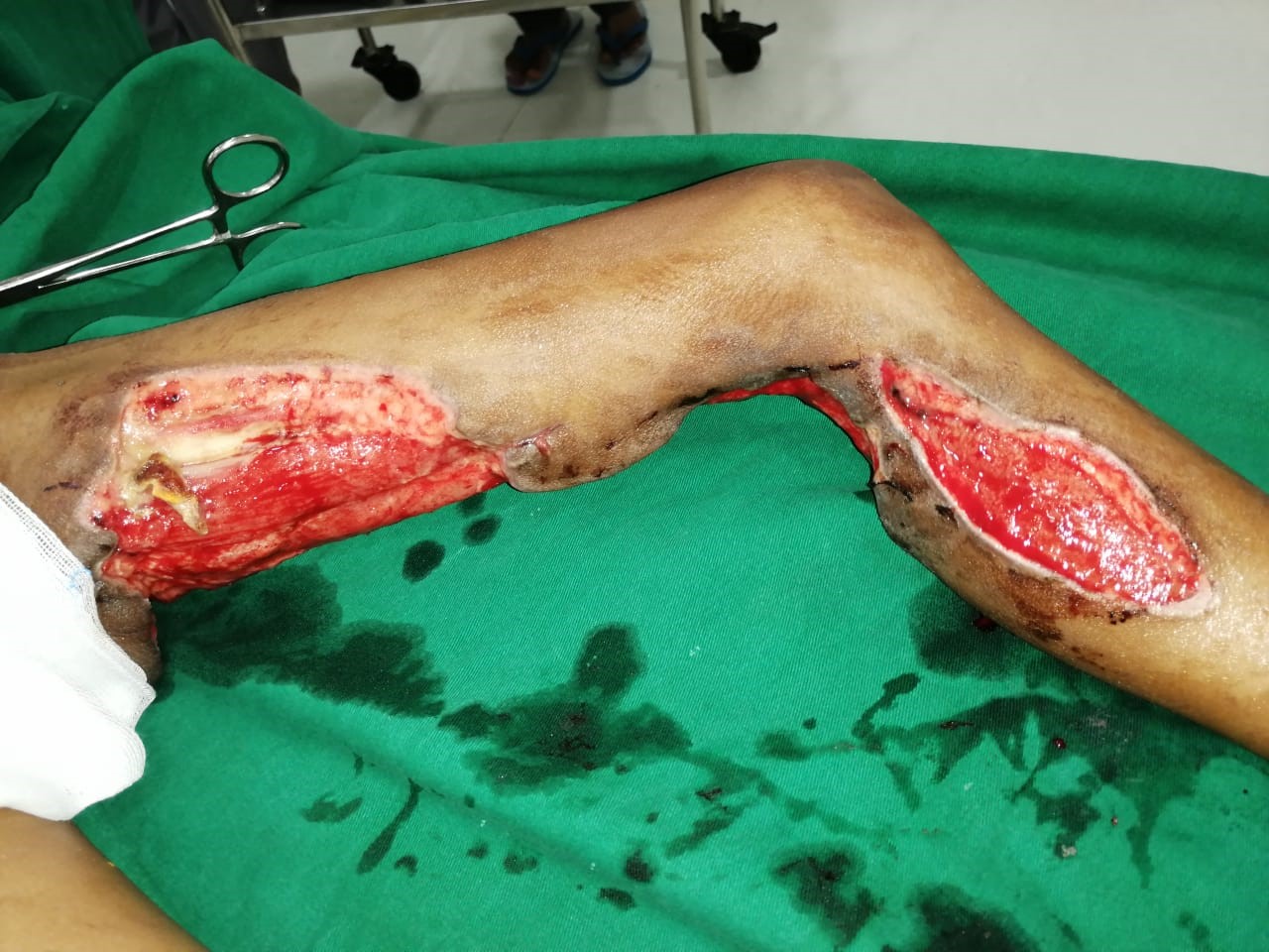 Paediatric acute compartment syndrome of the limbs due to fluid  extravasation: a case study - Wounds International