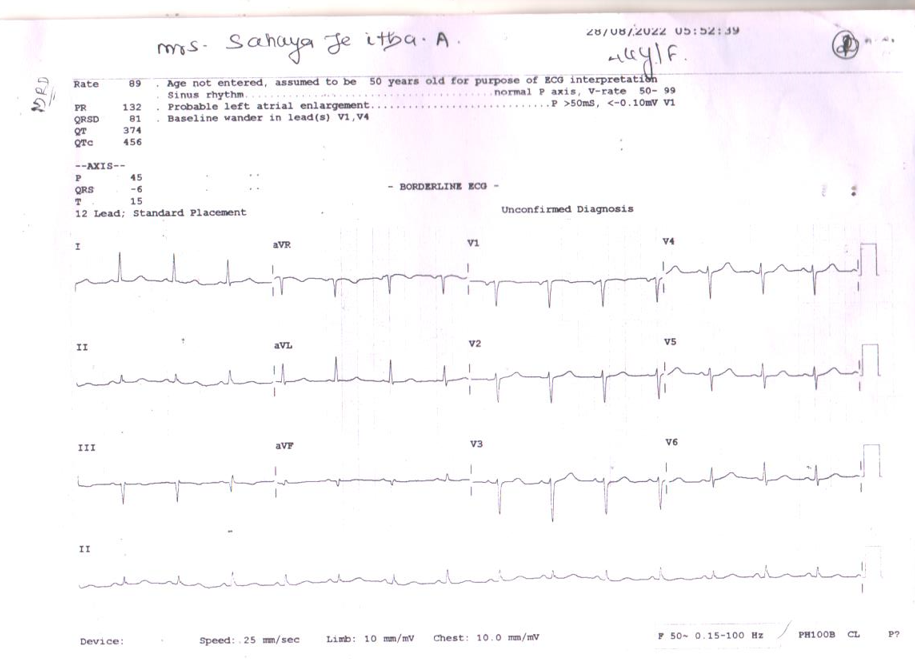 Pulmonary Thromboembolism ecg