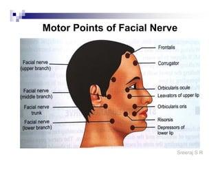 motor-points-of-facial-nerve