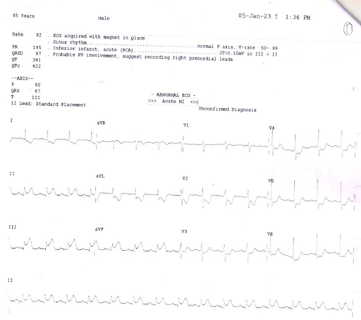 ECG-1