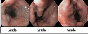 Grade-of-esophageal-varices