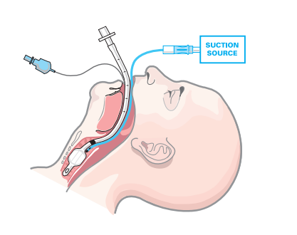 Endotracheal tube dedicated for subglottic secretions suctioning