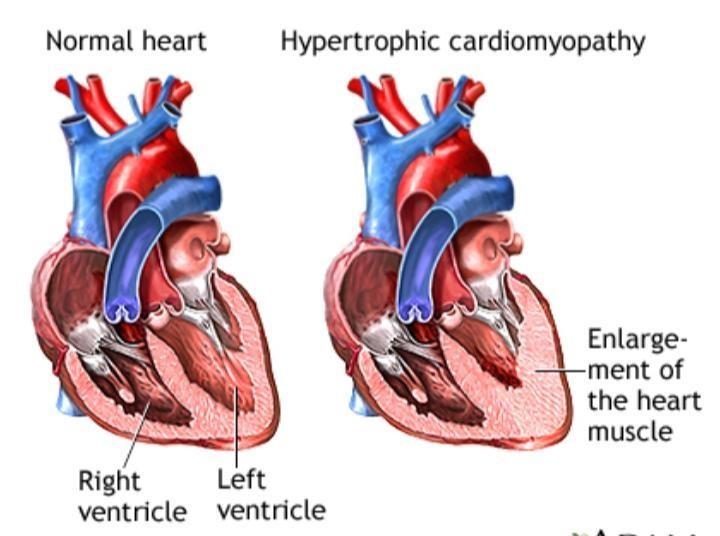 heart-trans1