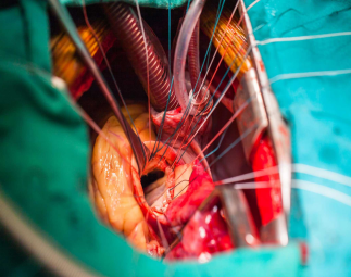Mitral-Valve-Replacement-1