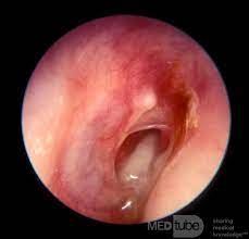 Otitis-Media