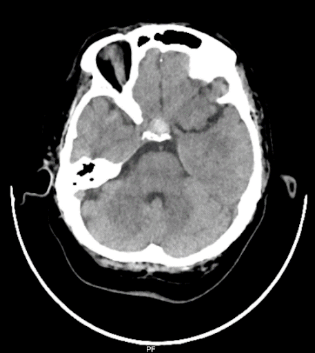 Pituitary-Macroadenom-3