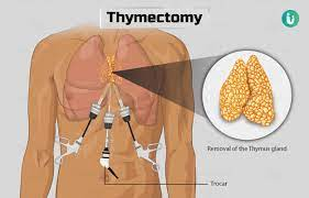 Thymectomy1