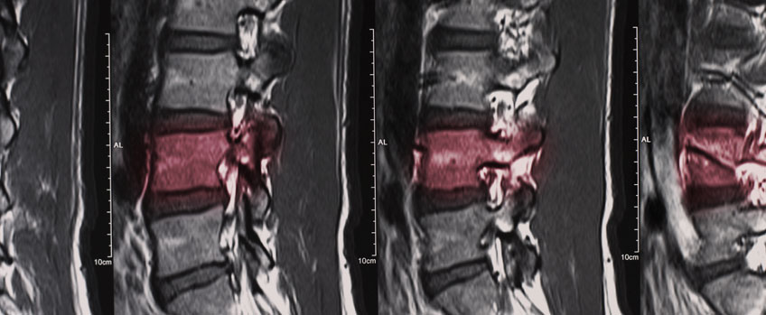 Spinal Fractures - Causes, Symptoms and Treatment