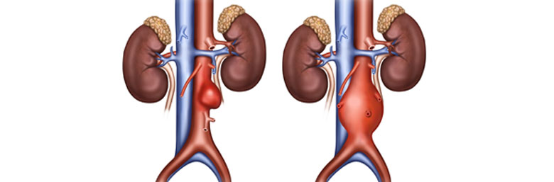 Aortic Aneurysm