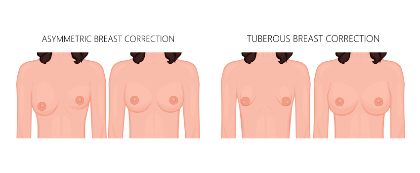 लाइव सर्जरी - Uneven Breasts या Underdeveloped Breasts का इलाज