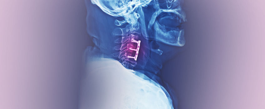 Occipital Cervical Junction Instability