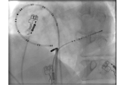 fluoroscopy 2