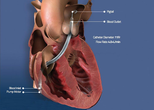 Understanding Paediatric Liver Transplant