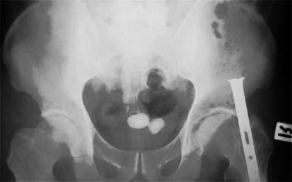 Giant stones of the urinary bladder with oval shapes, smooth surfaces