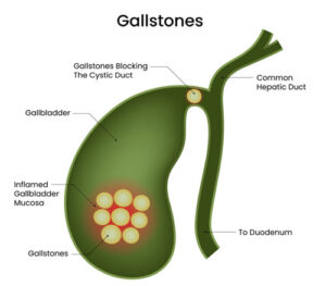 Cholelithiasis or Gall Stone Disease