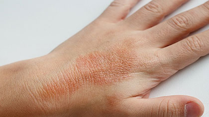 MANAGING ECZEMA IN THE ELDERLY