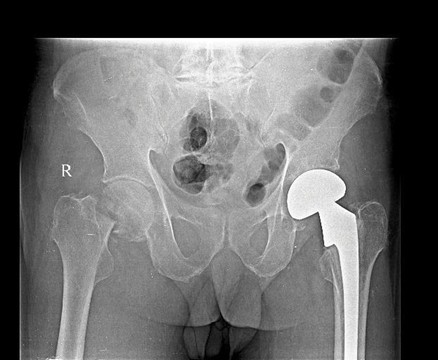 Fracture neck of femur with alkaptonuria: A case report - Kauvery Hospital